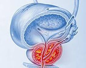 vnetje prostate s prostatitisom