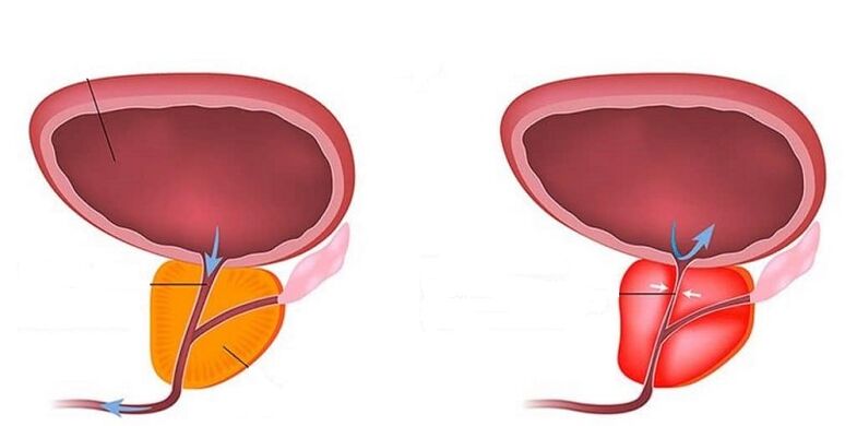 Zdrava in vneta prostata s prostatitisom