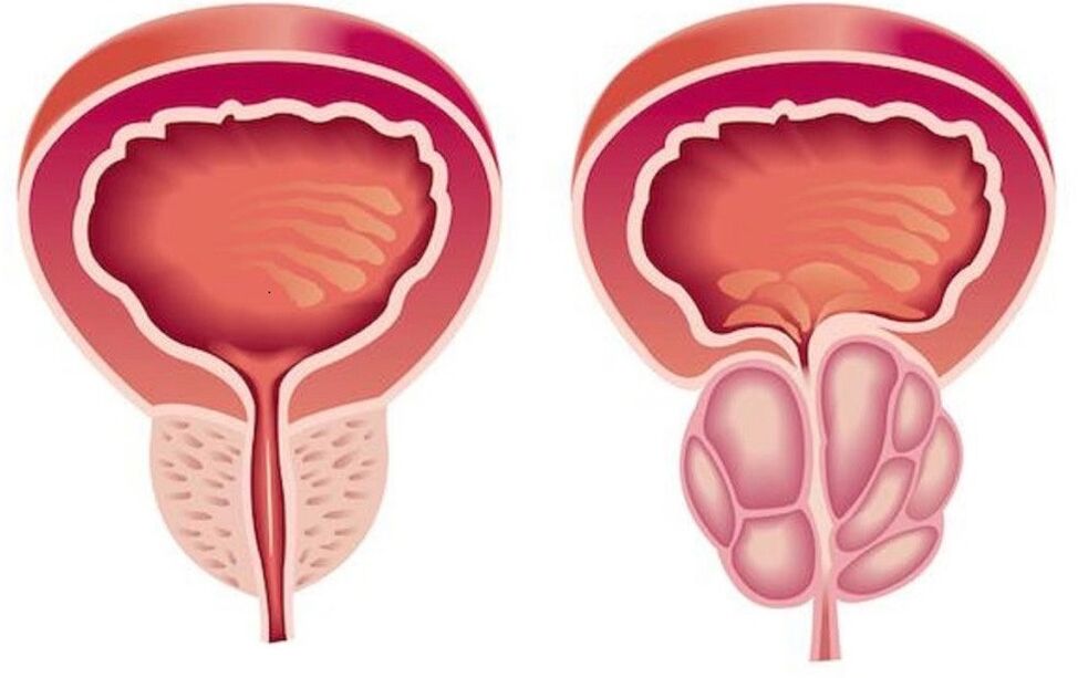 zdrava in vneta prostata s prostatitisom